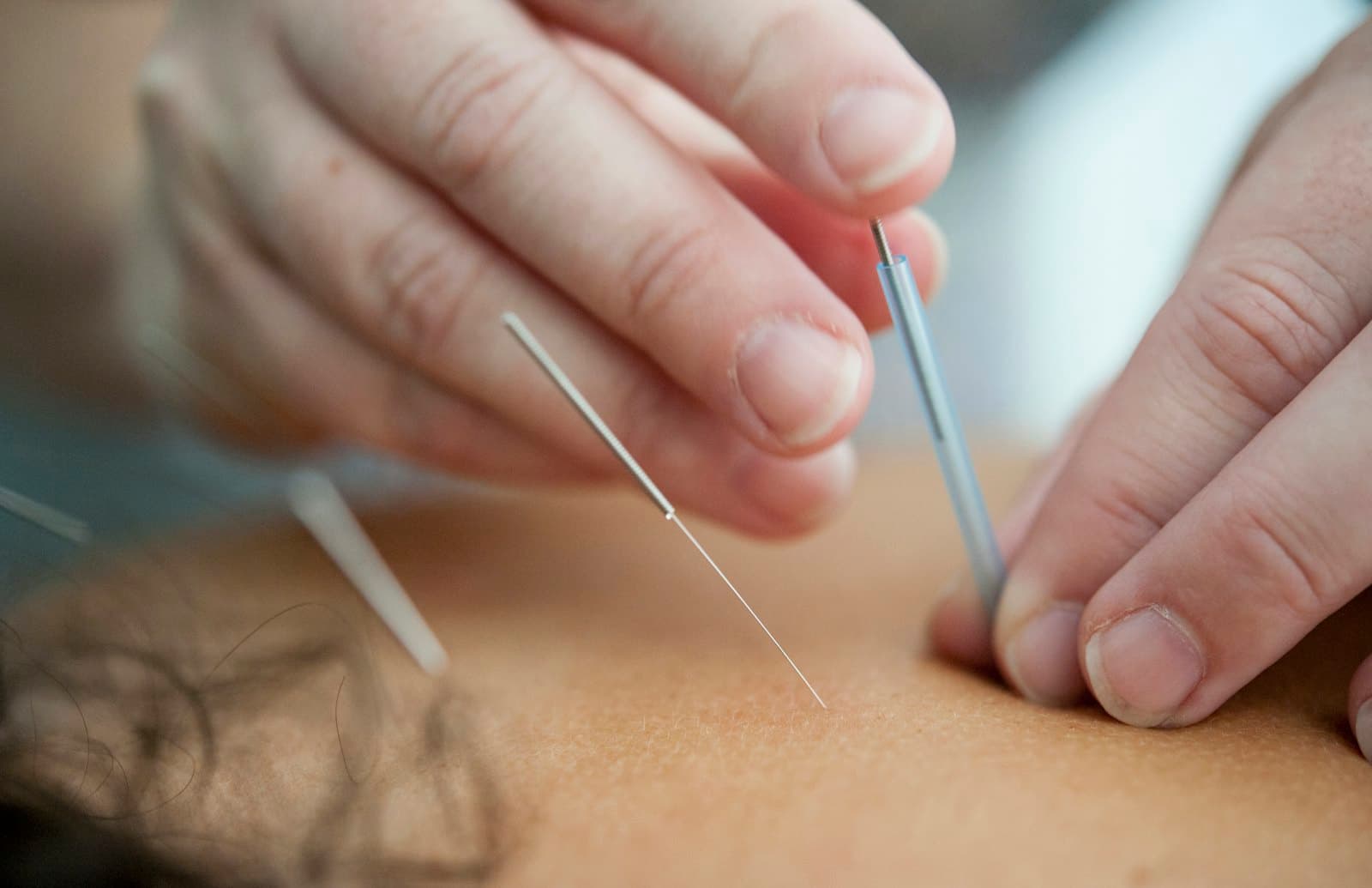Practitioner placing an acupuncture needle